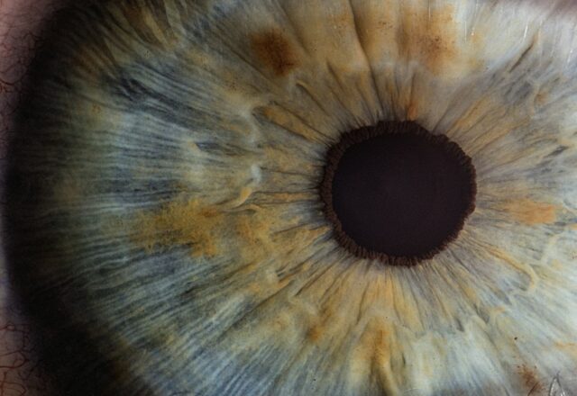 Botoks Sonrası Göz Kapağı Neden Düşer